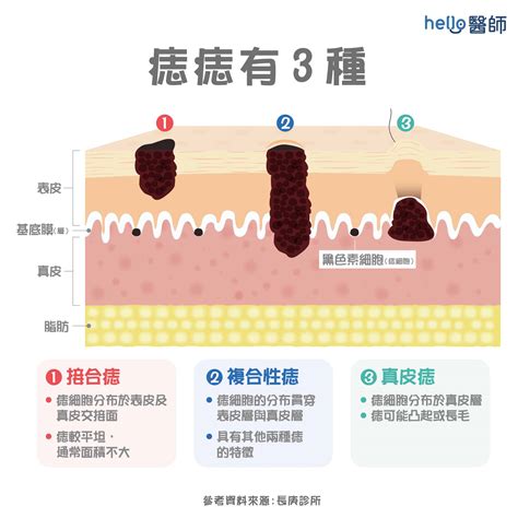 身上痣多|痣形成的原因？痣長毛、痣變多變大是痣病變？5招判別